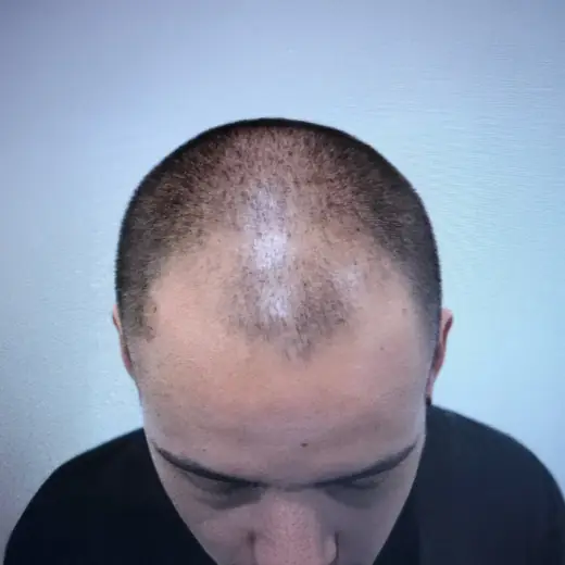 Voor haartransplantatie, Steven Kwik