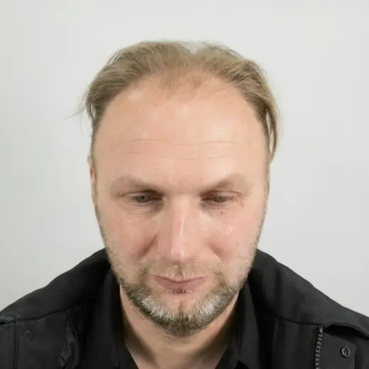 Voor haartransplantatie, Steven Van Den Tillaart