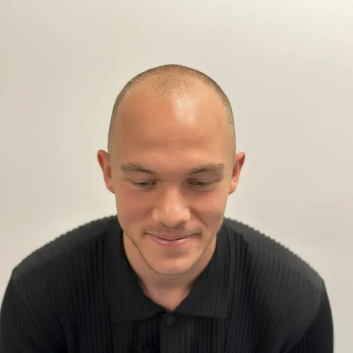 Tein Troost, voor de haartransplantatie
