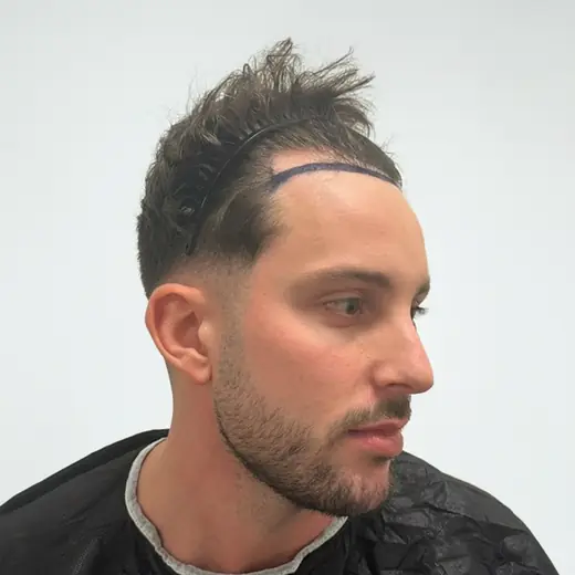 Voor haartransplantatie, Theo Tsantos