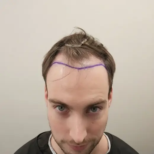 Voor haartransplantatie, Tim Tamming