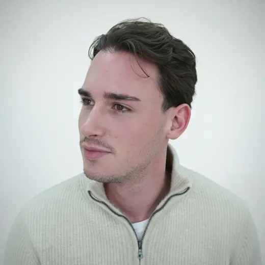 Voor haartransplantatie, Timo Van Der Hart