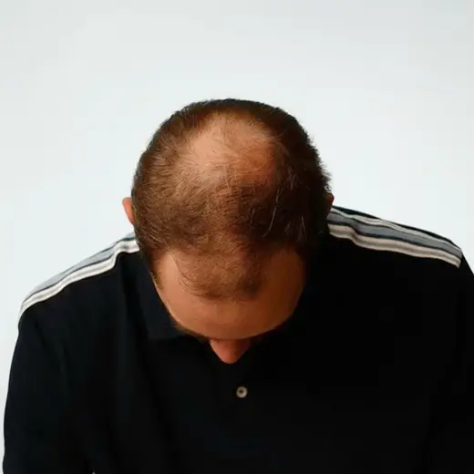 Voor haartransplantatie, Tjeerd Thuss