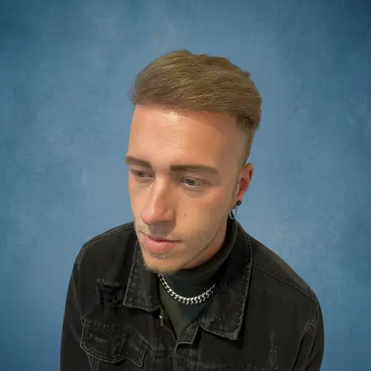 Na haartransplantatie, Tristan