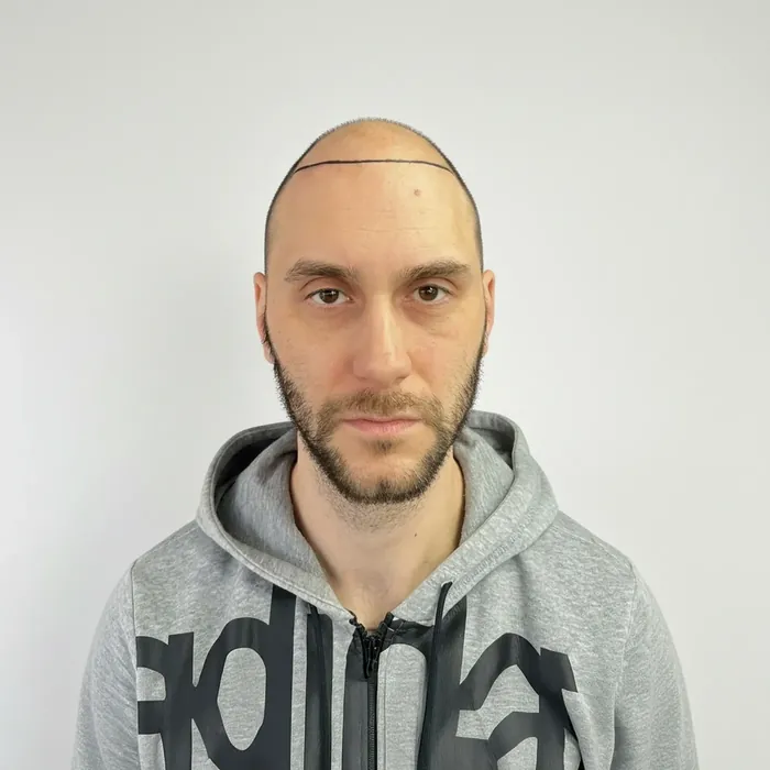 Wesley Warrink, voor de haartransplantatie